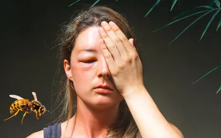 Bras avec rougeur localisée après piqûre d'insecte en extérieur